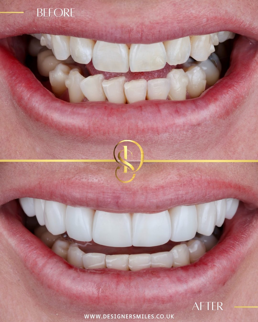 3D composite bonding at Designer Smiles, before and after