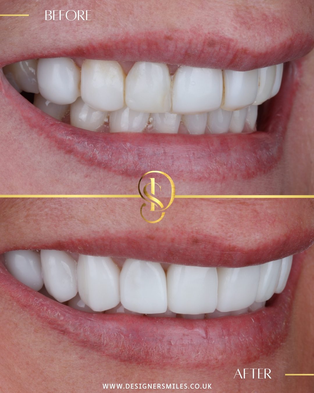 3D composite bonding at Designer Smiles, before and after