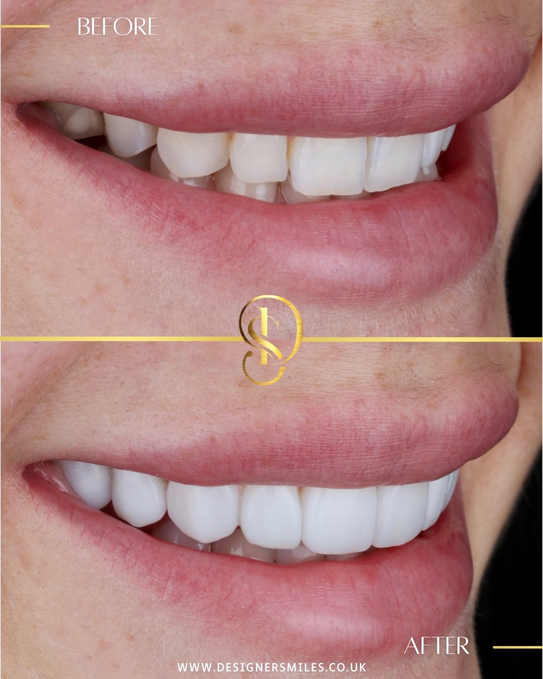 3D composite bonding at Designer Smiles, before and after