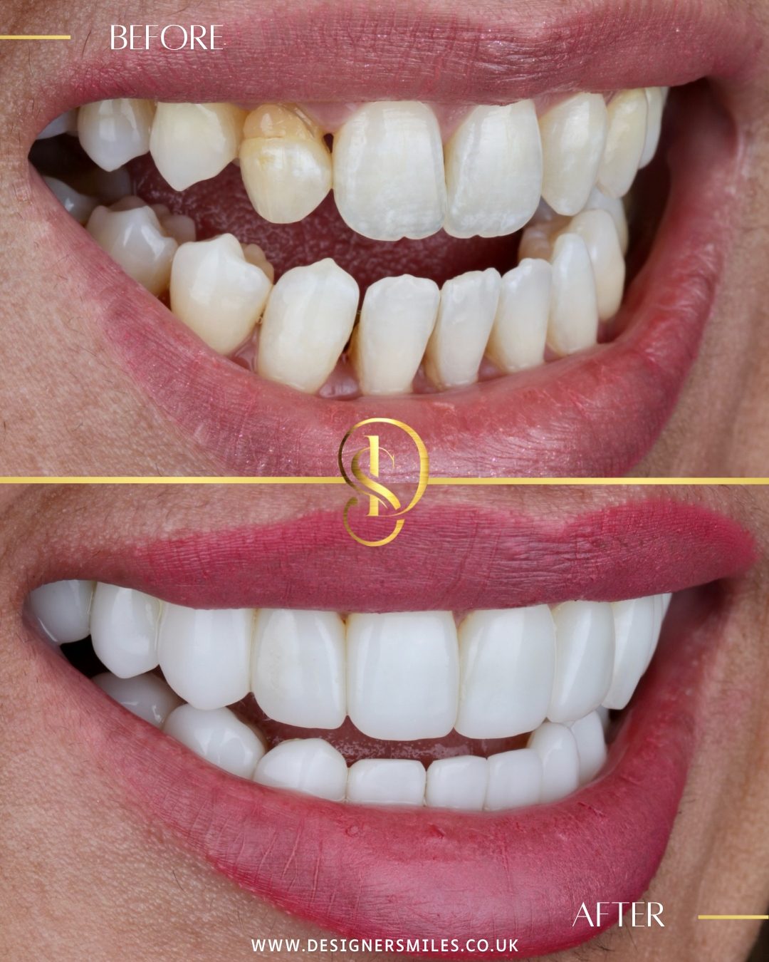 3D composite bonding at Designer Smiles, before and after