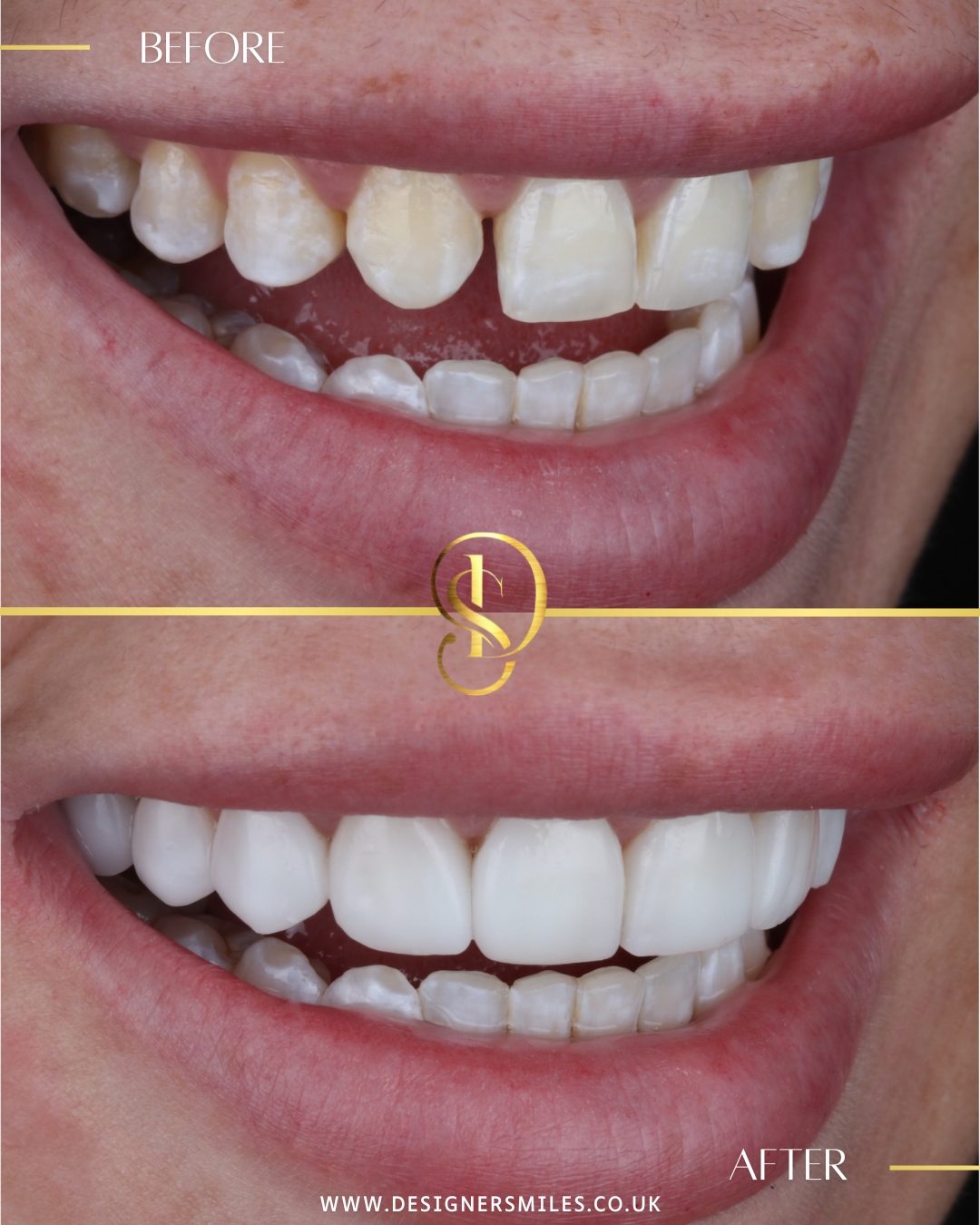 3D composite bonding at Designer Smiles, before and after