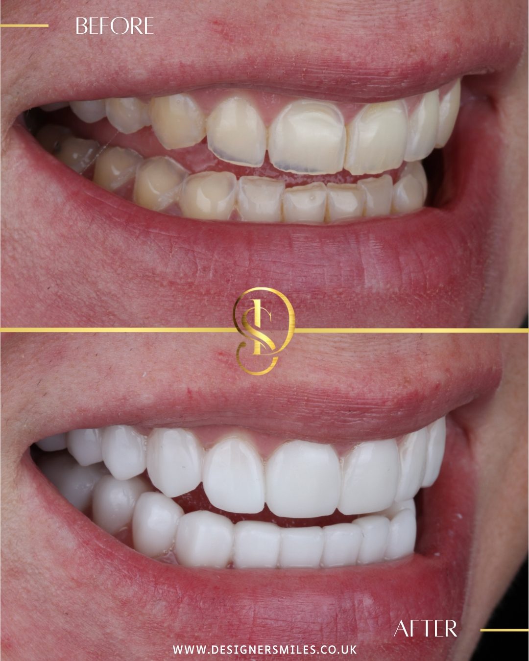 3D composite bonding at Designer Smiles, before and after