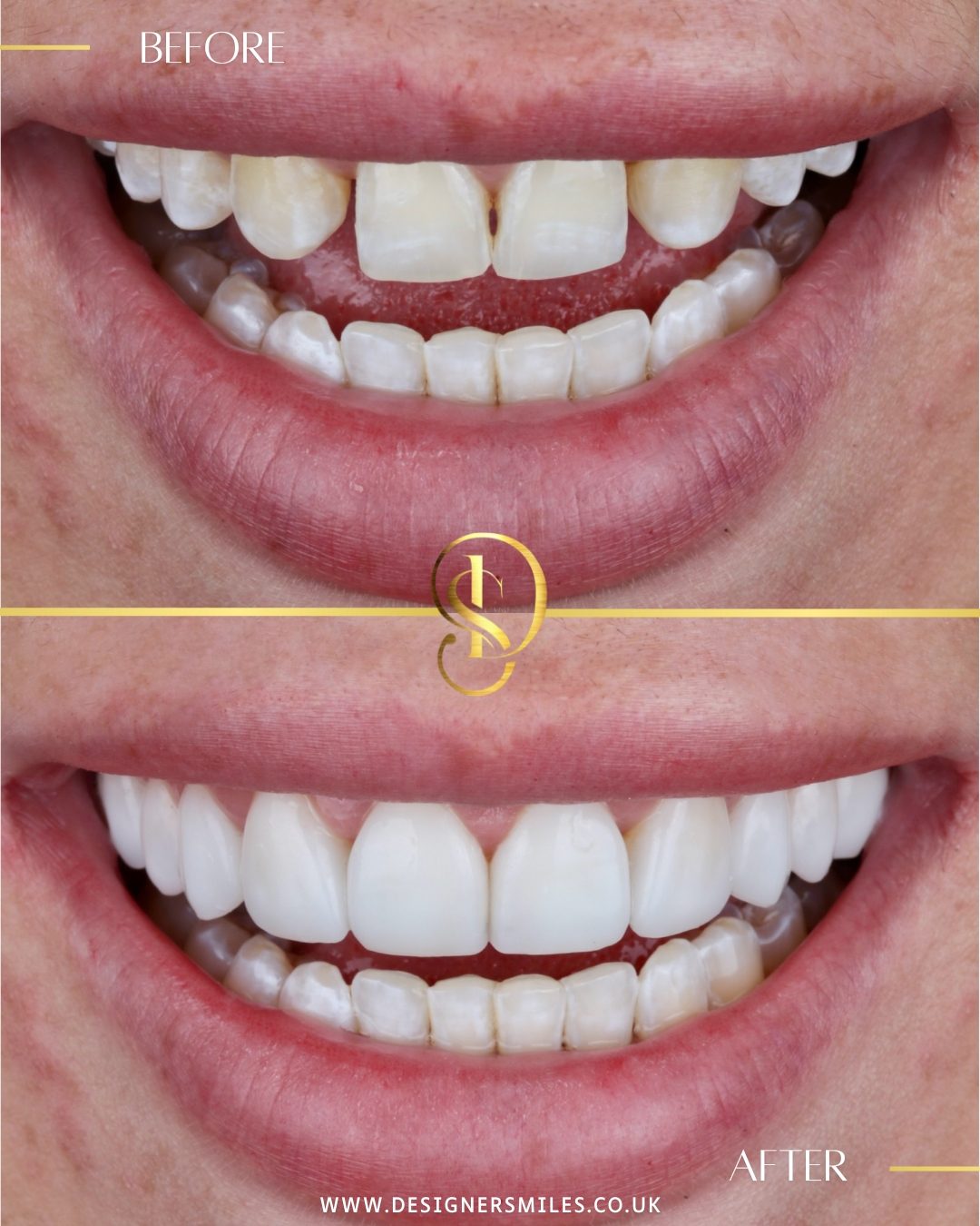 3D composite bonding at Designer Smiles, before and after