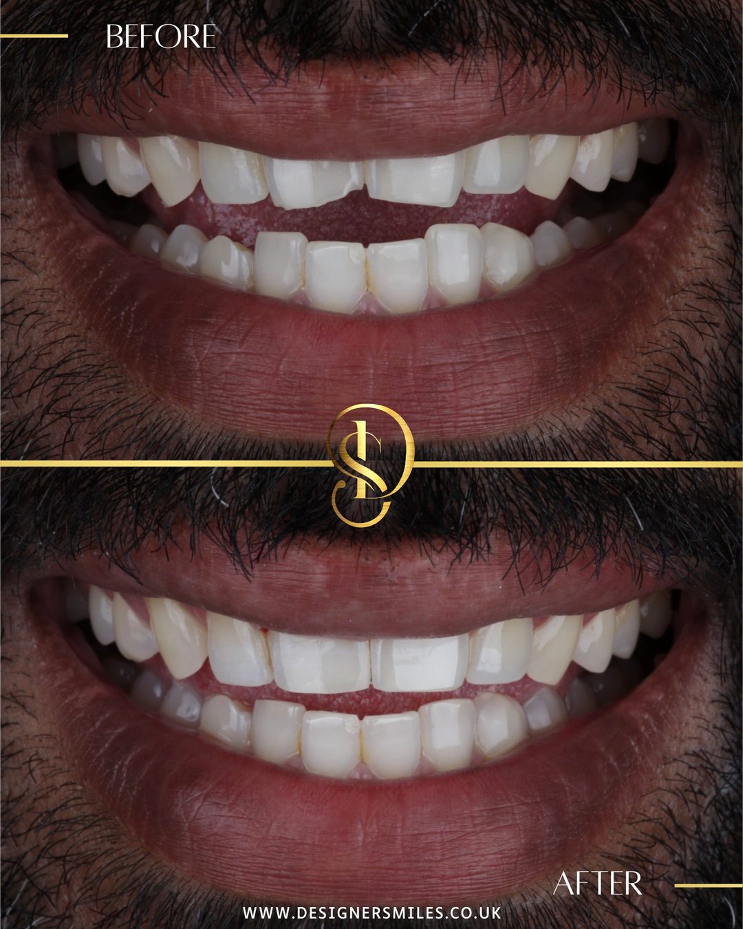 Composite edge bonding at Designer Smiles, before and after