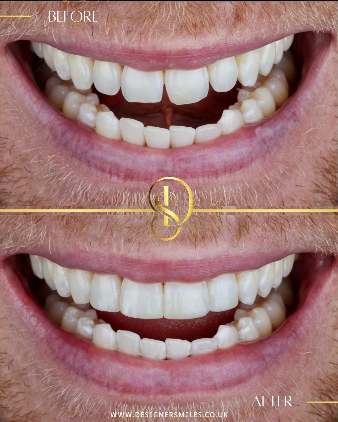 Composite edge bonding at Designer Smiles, before and after