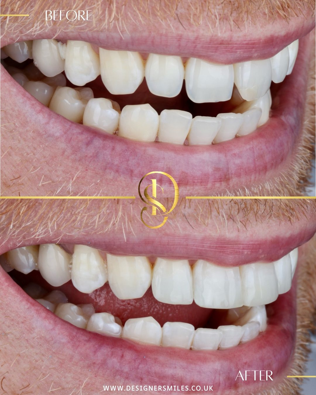 Composite edge bonding at Designer Smiles, before and after