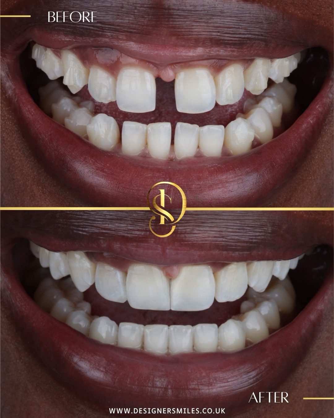 Composite edge bonding at Designer Smiles, before and after