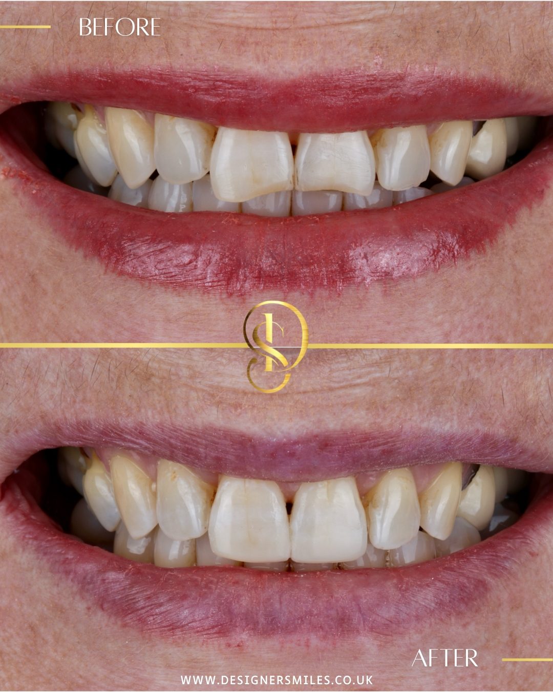 Composite edge bonding at Designer Smiles, before and after