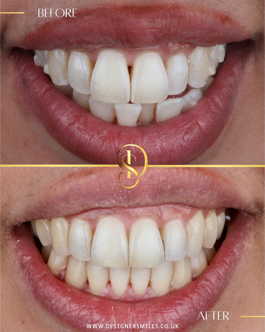 Invisalign at Designer Smiles, before and after