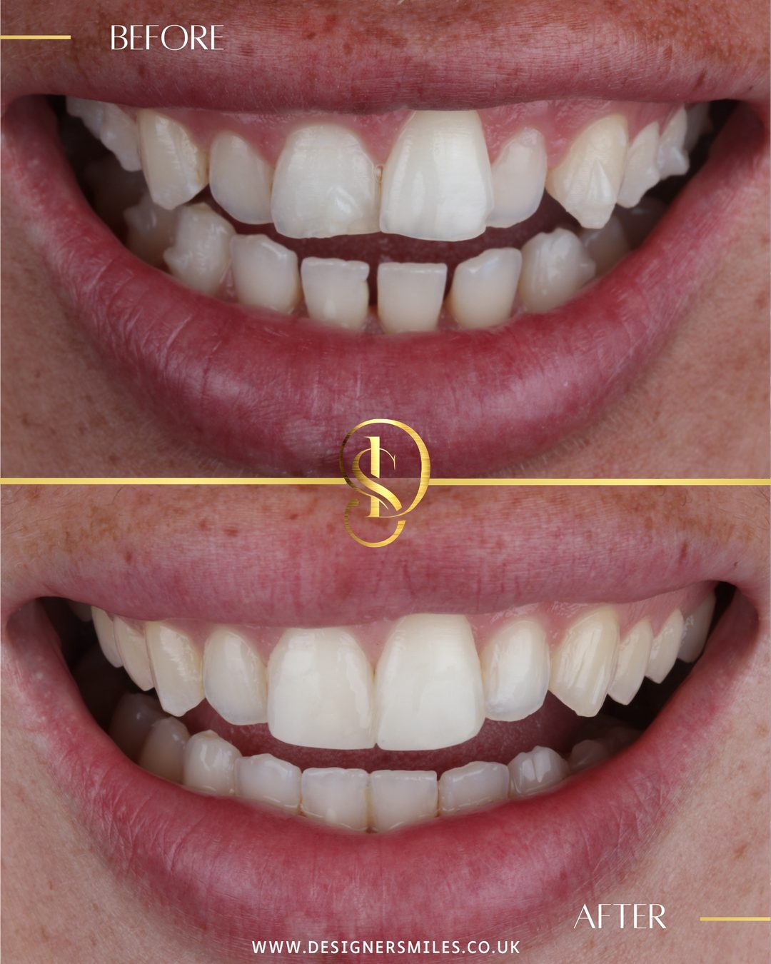Invisalign at Designer Smiles, before and after