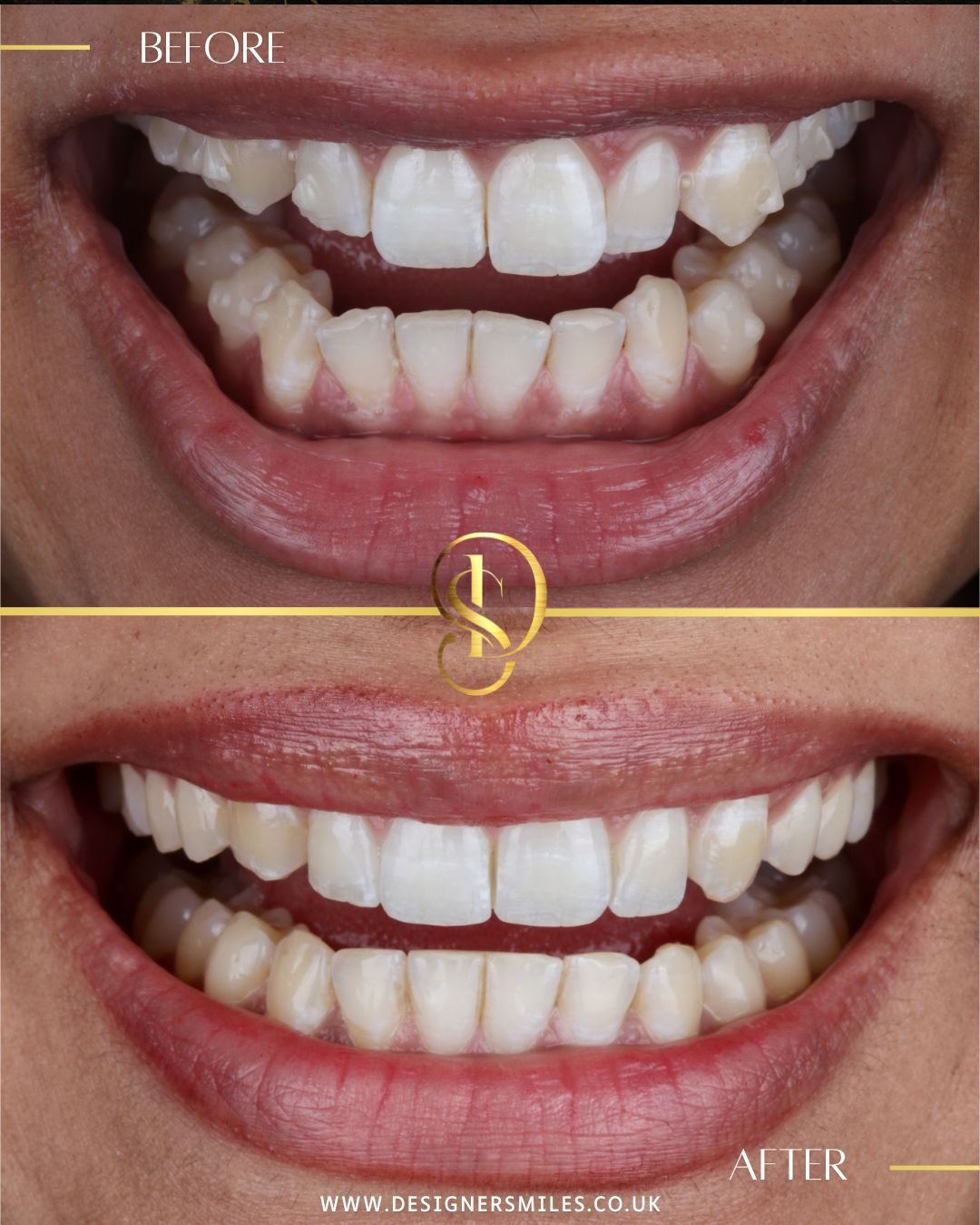 Invisalign at Designer Smiles, before and after