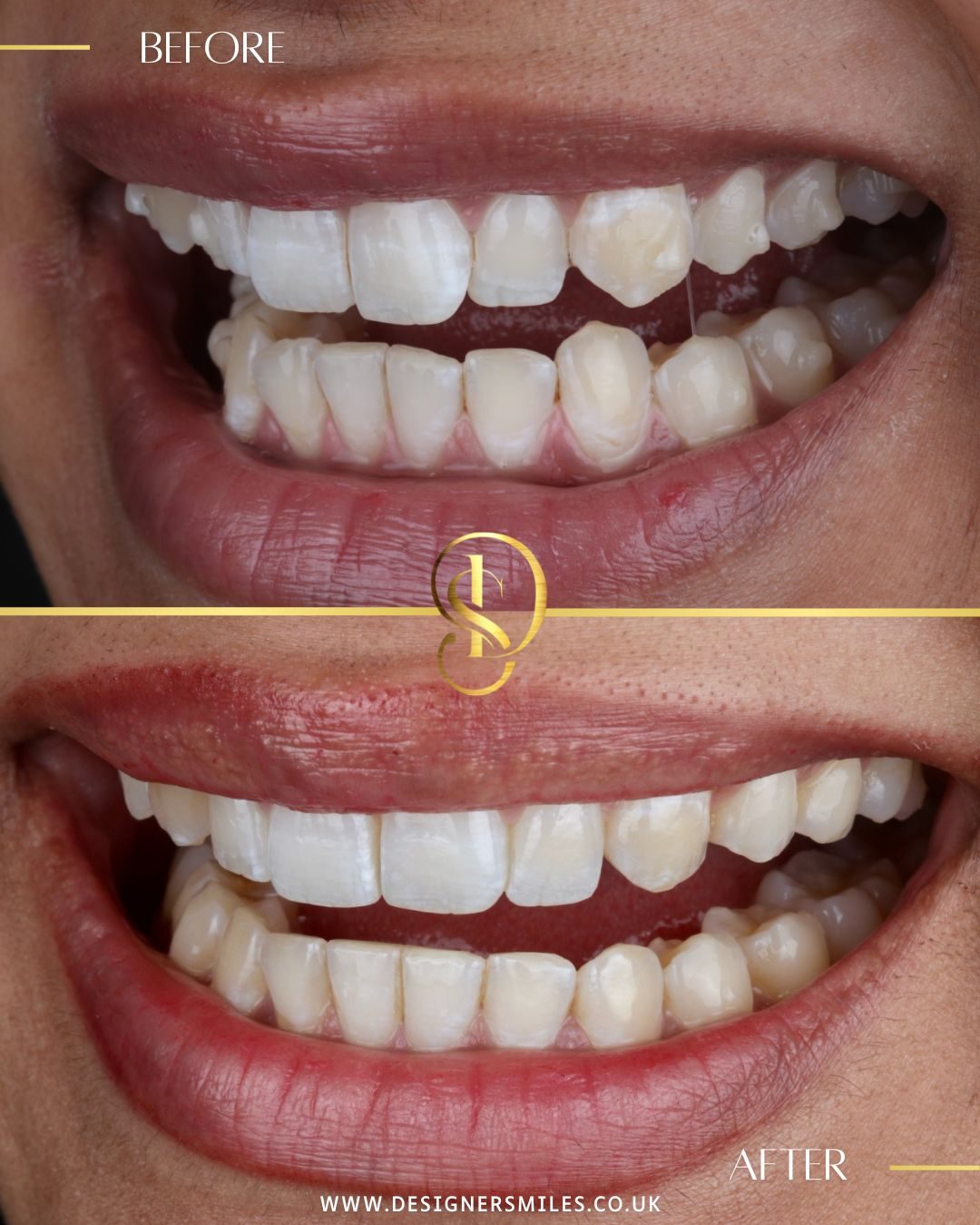 Invisalign at Designer Smiles, before and after