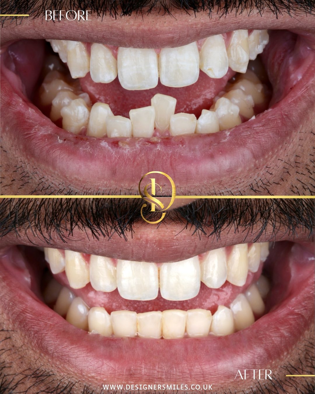 Invisalign at Designer Smiles, before and after