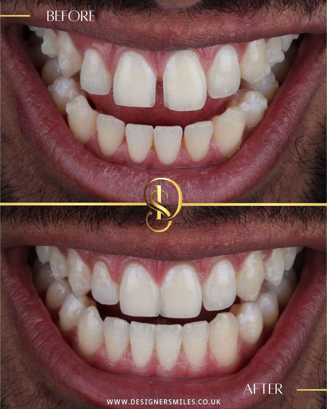 Invisalign at Designer Smiles, before and after
