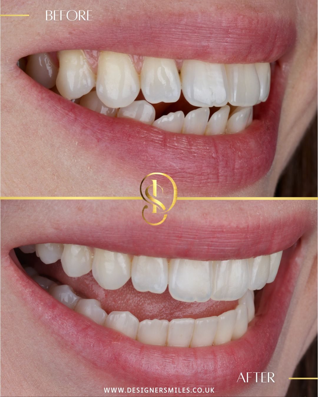 Invisalign at Designer Smiles, before and after