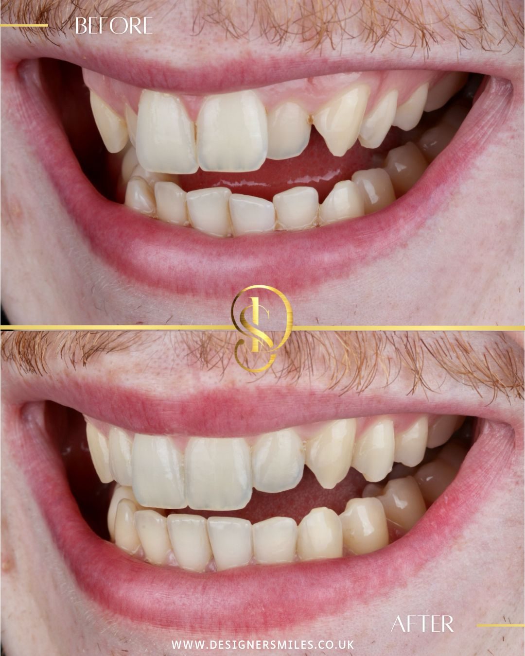 Invisalign at Designer Smiles, before and after